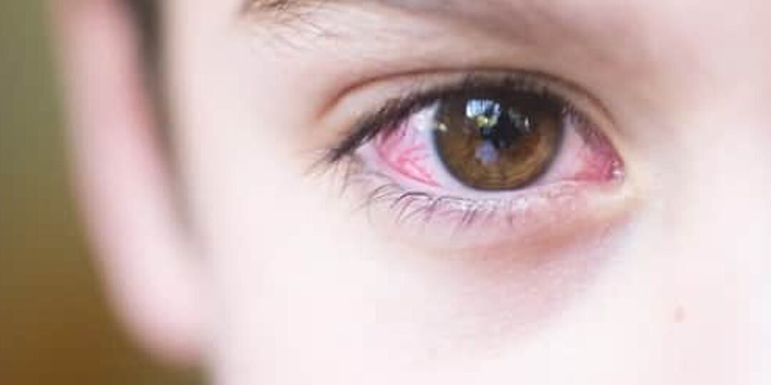 conjutiviteemcriancasoftalmologia